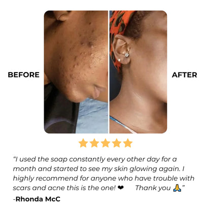 😍50% KORTING - BIOLOGISCHE Citroen Kurkuma en Kojinezuur Huidverhelderende Zeep (🔥MOEDERDAG🔥) 