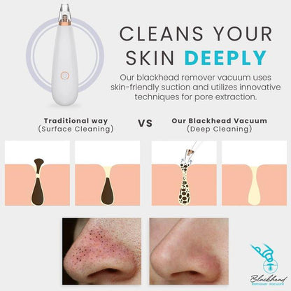 Blackhead Remover Vacuum