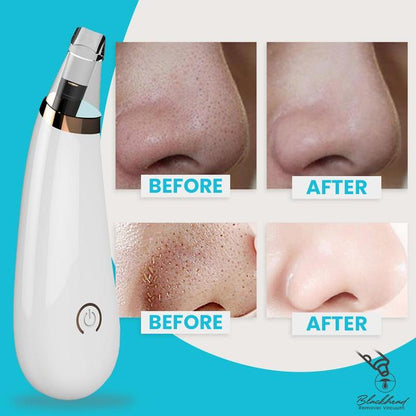 Blackhead Remover Vacuum